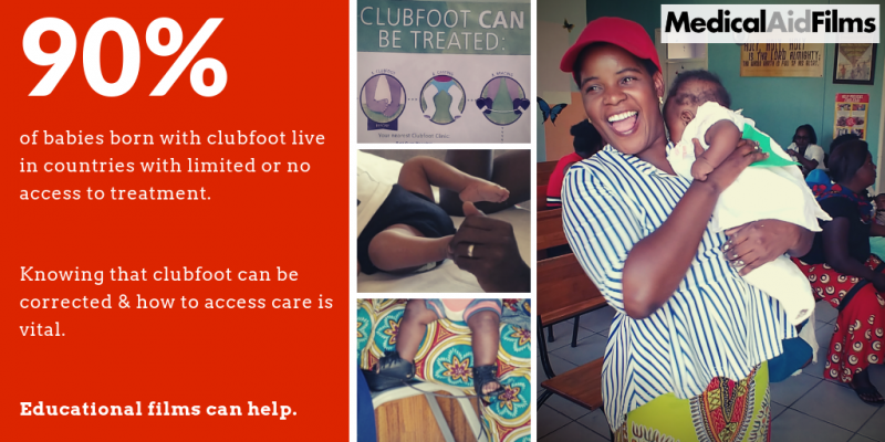 90% of babies born with clubfoot live in countries with limited or no access to treatment